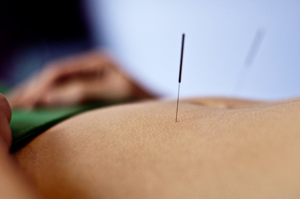 infertility acupuncture denver